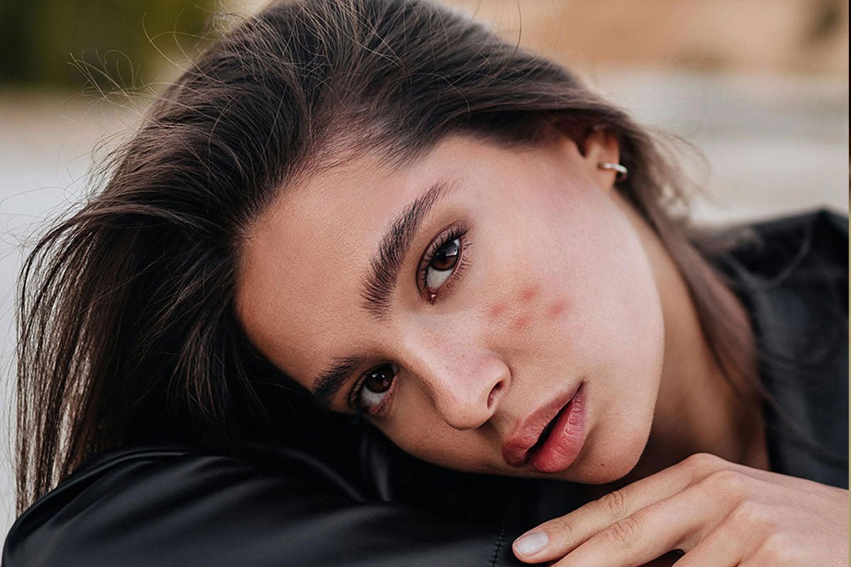 Her Dark Spots Made Her Invisible—Until She Found This Life-Changing Secret! - RorikoConnect