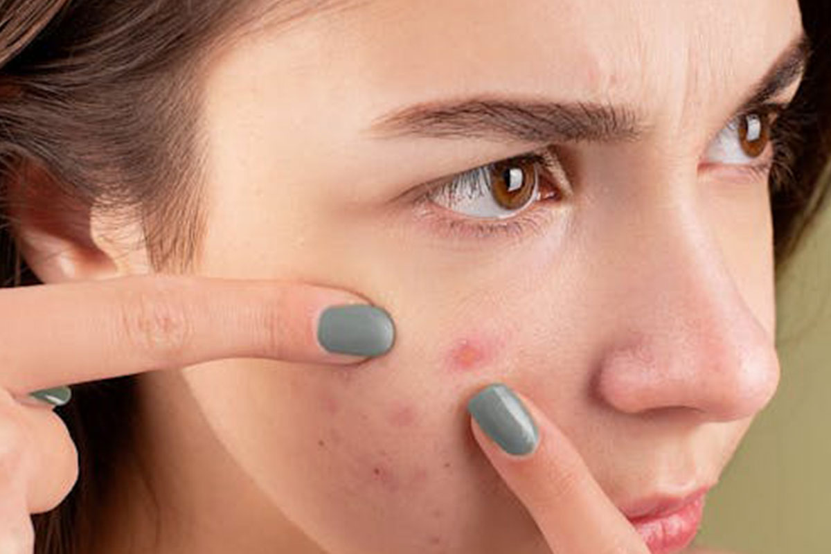 She Was Rejected for Her Pimples—Until This Secret Changed Everything!